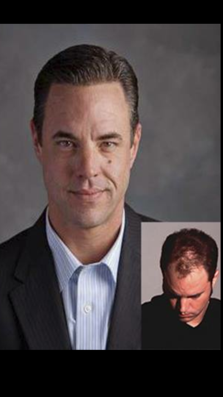 The Psychological Shift: Moving From Hiding Hair Loss to Owning Your Transformation